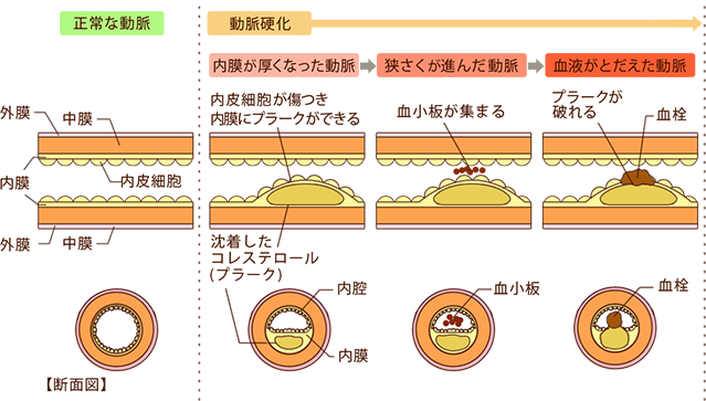 動脈硬化のメカニズム